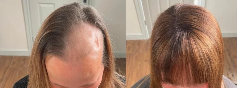 Hairloss Courses